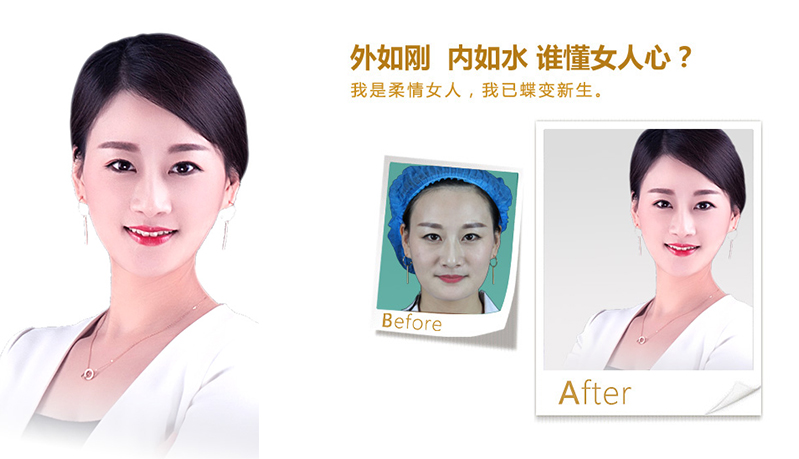 杭州V脸、线雕隆鼻